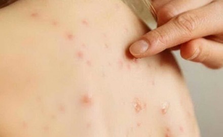 Coronavirus si vede sulla pelle. Ecco i segnali per individuarlo